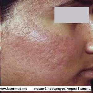 Лазерное лечение акне и рубцов постакне в Молдове ! Laser Med – Кабине