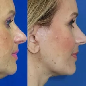 Lifting facial – spune adio ridurilor profunde 