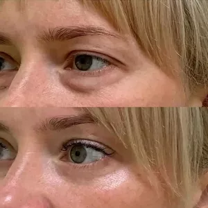 Blefaroplastie inferioară – înlătură pungile de sub ochi