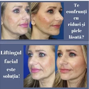 Lifting facial pentru un profil facial tânăr