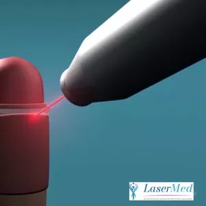 Circumcizia cu laser (ablatia laser a preputului) la bărbații in Moldo