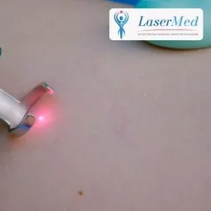 Лазерное лечение купероза,  телеангиоэктазий,  Лазерное удаление сосудов