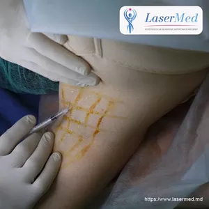 Tratamentul cu laser a  hiperhidrozei axilare in Moldova!