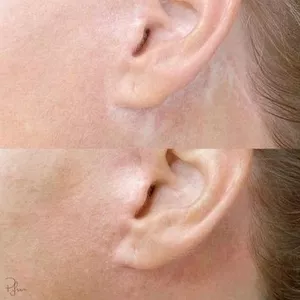Tratament cu laser pentru indepartarea si  eliminarea,  (corectia) cicatricelor  in cabinetul de chirurgie laser “LaserMedChisinau” in Moldova!