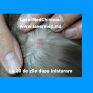 Tratamentul hemangioamelor cu Laser in Moldova