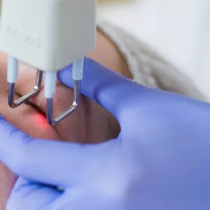 Blefaroplastie cu laser (Chirurgia laser estetica a pleoapelor) in (Ch