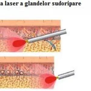 Tratamentul cu laser a hiperhidrozei axilare in Moldova!