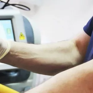 Inlaturarea cu laser (eliminrea,  indepartarea) verucilor,  papiloamelor,  negilor si condiloamelor genitale in (Chisinau) Moldova!